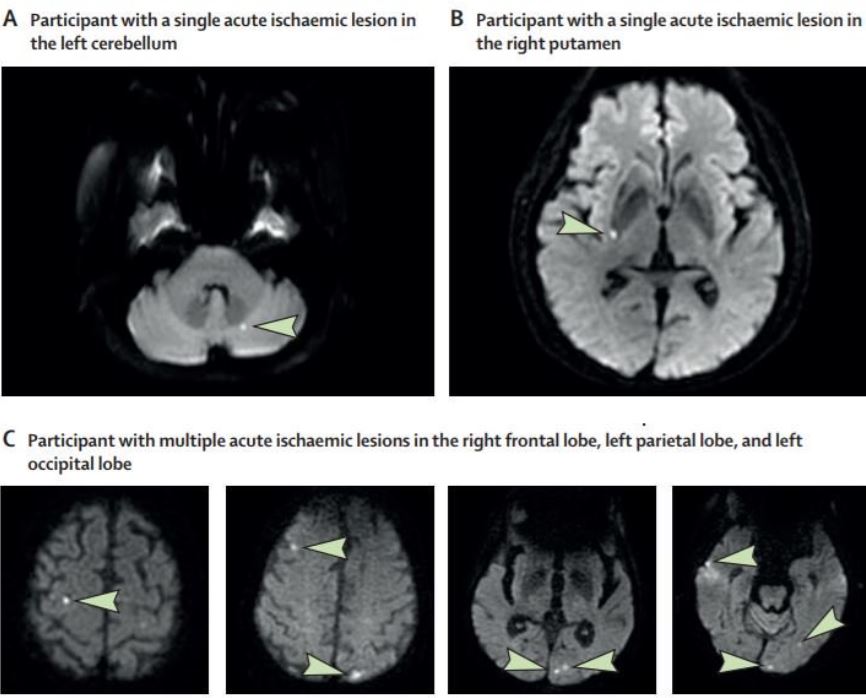 The Lancet Covert Strokes Aug 16 2019