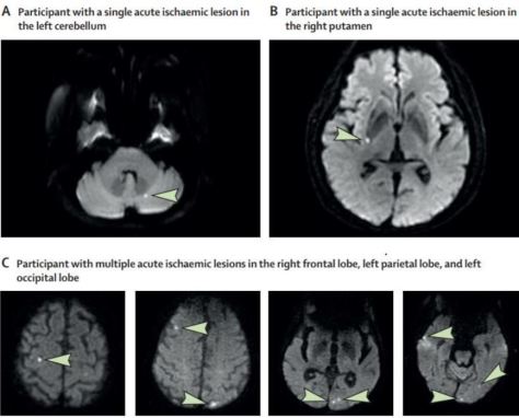 The Lancet Covert Strokes Aug 16 2019