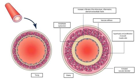 Artery Stiffness