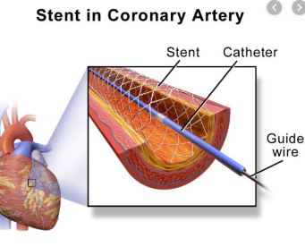 Stent in Coronary Artery