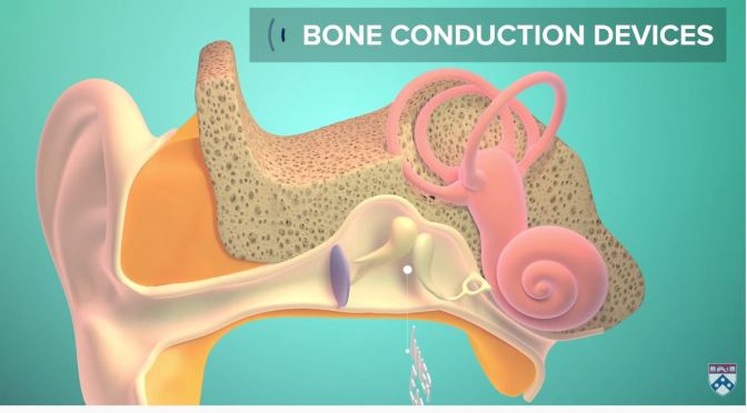 Medical Care: “Restoring Hearing Loss – The Patient Experience” (Penn ENT)
