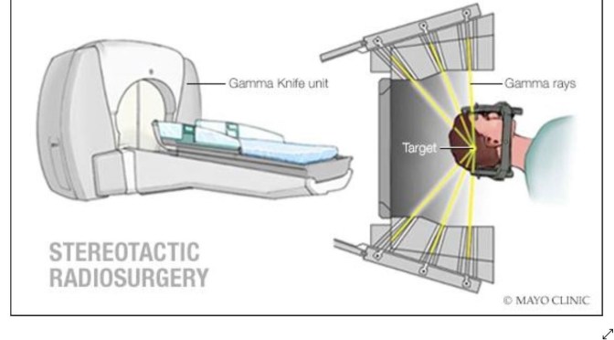 Medical Procedures: How “Gamma Knife” Surgery Treats Brain Tumors