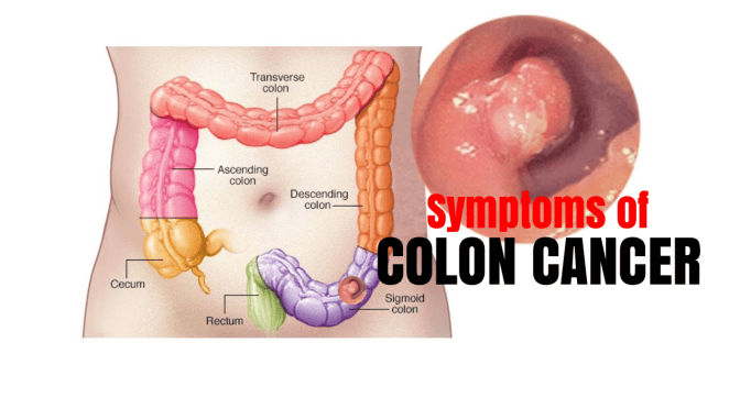 Medical Health Videos: “Symptoms Of Colon Cancer” (Mayo Clinic)