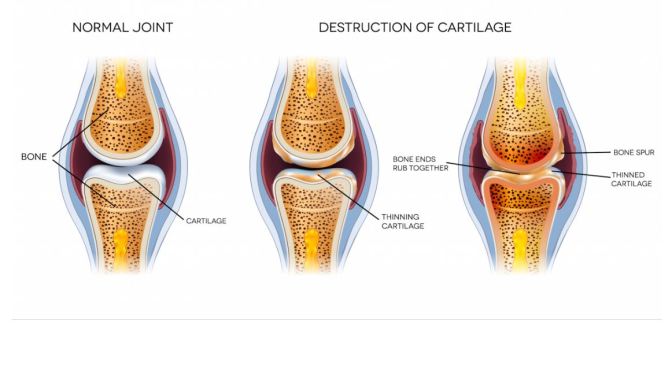 Stanford: Researchers Find Way To “Regrow” New Cartilage In Joints