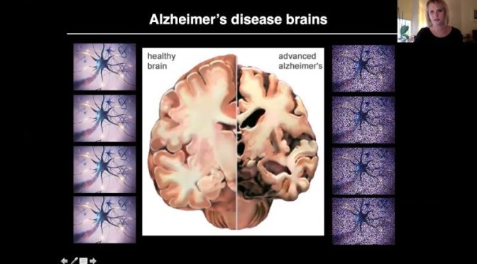Alzheimer’s Disease: ‘How It Starts & Progresses’