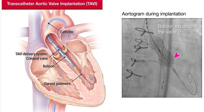 Medicine: Transcatheter Treatments For Valvular Heart Disease (JAMA Video)
